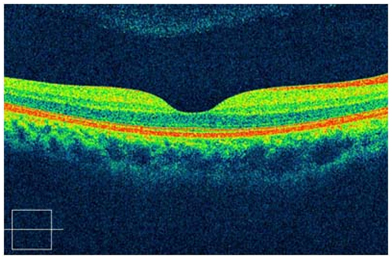 (Imagen tomada de base de datos equipo OCT Cirrus Sociedad De Diagnóstico Visual SAS)